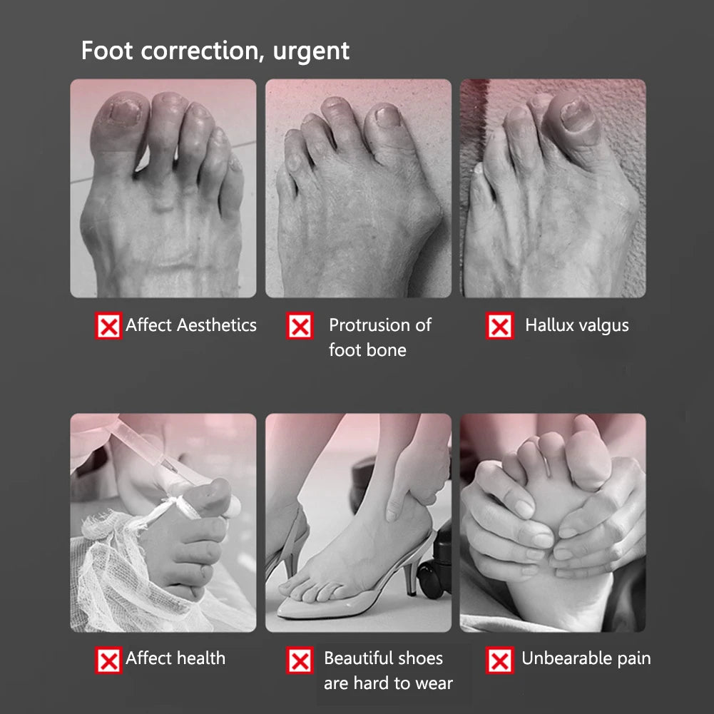 Correcteur d’Orteil – Ajustement Doux et Correction Progressive